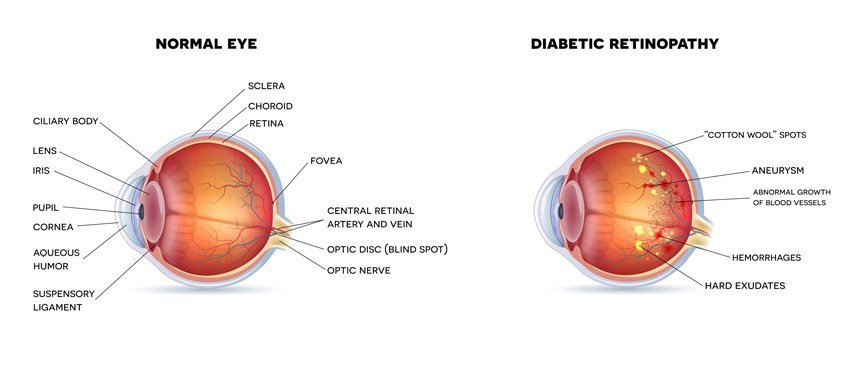Diabetic Retinopathy Condition Diabetic Retinopathy Condition