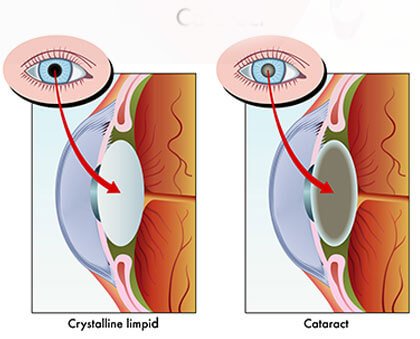 Cataract surgery in Binghamton