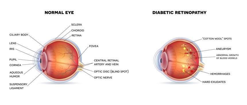 Diabetic Retinopathy Condition