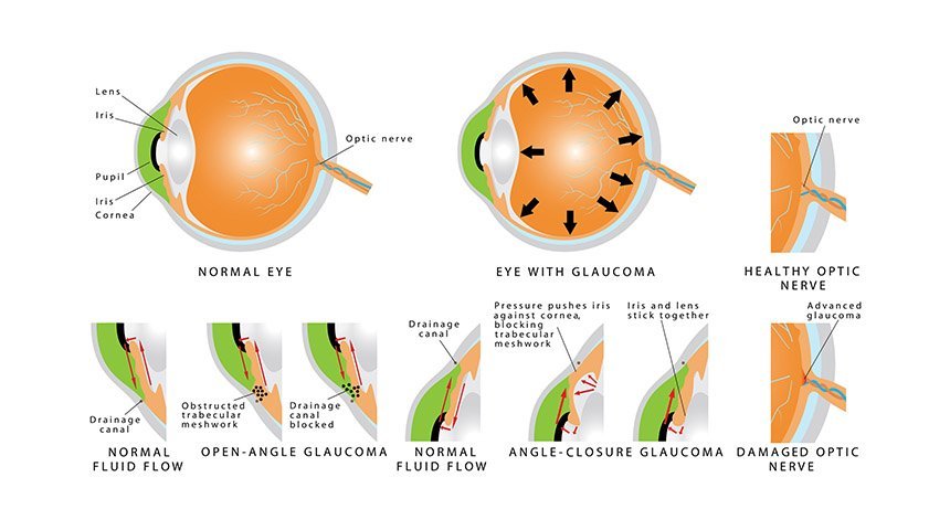 Stages of Glaucoma