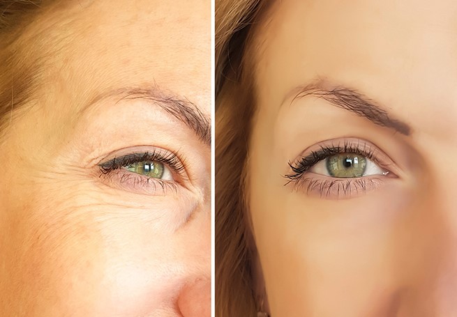 Before and after eyelid surgery